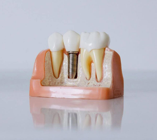 Dental Implant Mosman