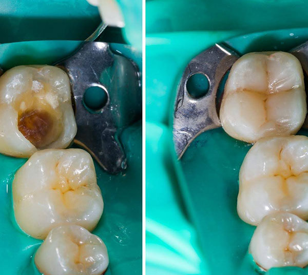 Fillings and Restorations Before and After